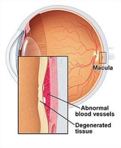 macular-degeneration