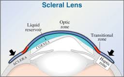 Sclera Lenses